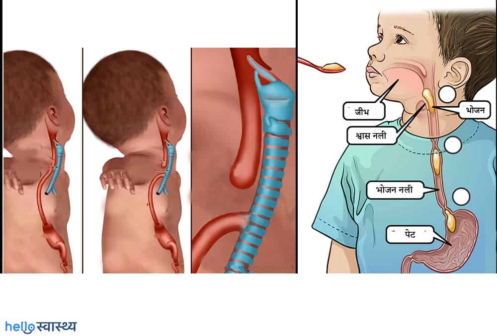 Tracheoesophageal Fistula : ट्रैचियोइसोफैगल फिस्टुला क्या है?