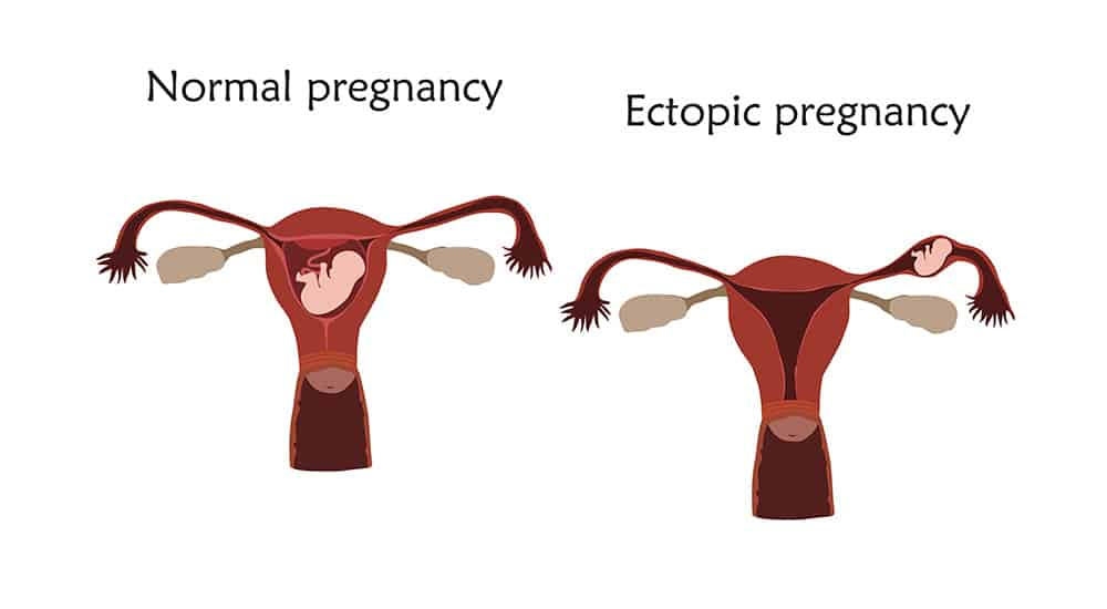 एक्टोपिक प्रेग्नेंसी-Ectopic pregnancy
