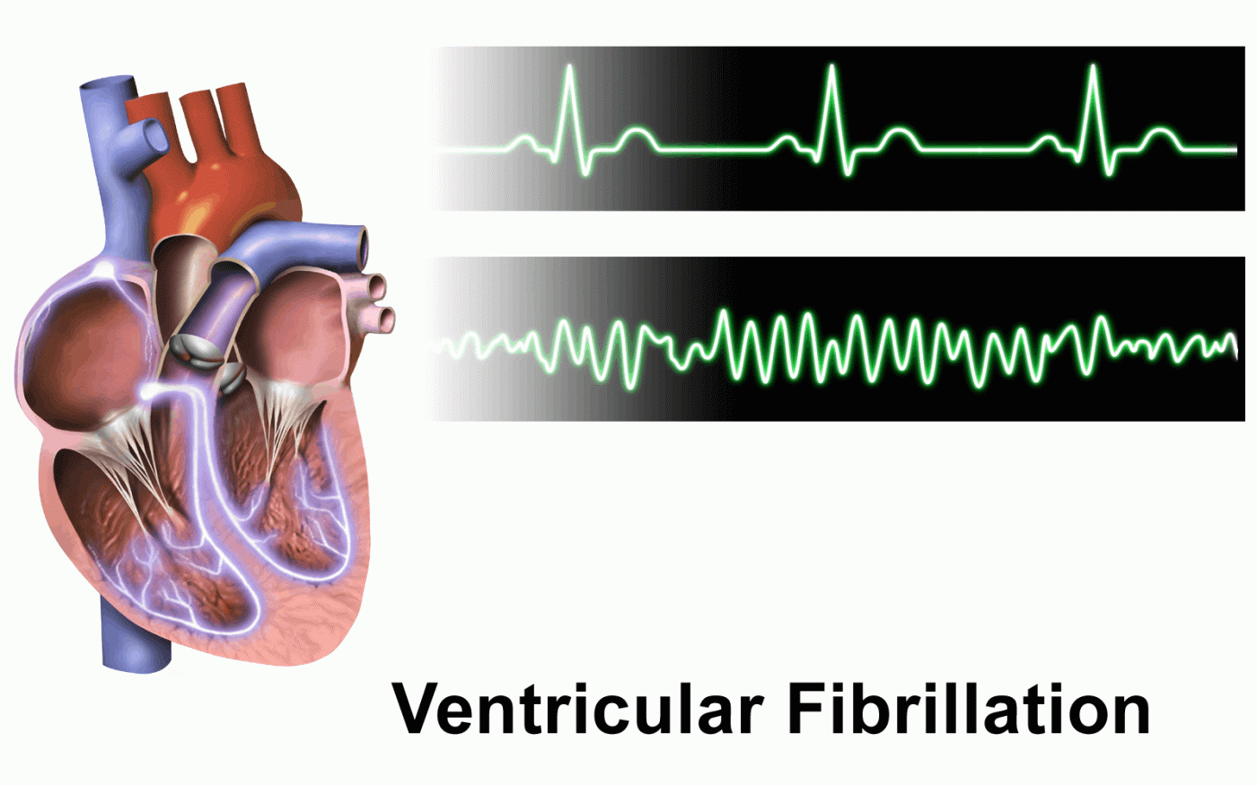 Ventricular fibrillation (V-fib): वेंट्रिक्युलर फाइब्रिलेशन क्या है?