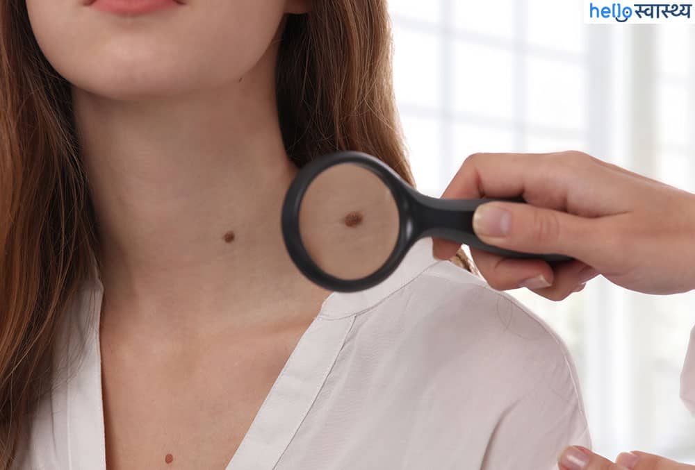 प्रेग्नेंसी के दौरान स्किन टैग क्यों होता है, जानिए इसके कारण और उपचार