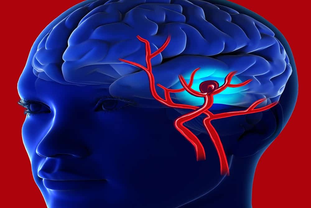 Brain Aneurysm : ब्रेन एन्यूरिज्म (मस्तिष्क धमनी विस्फार) क्या है?