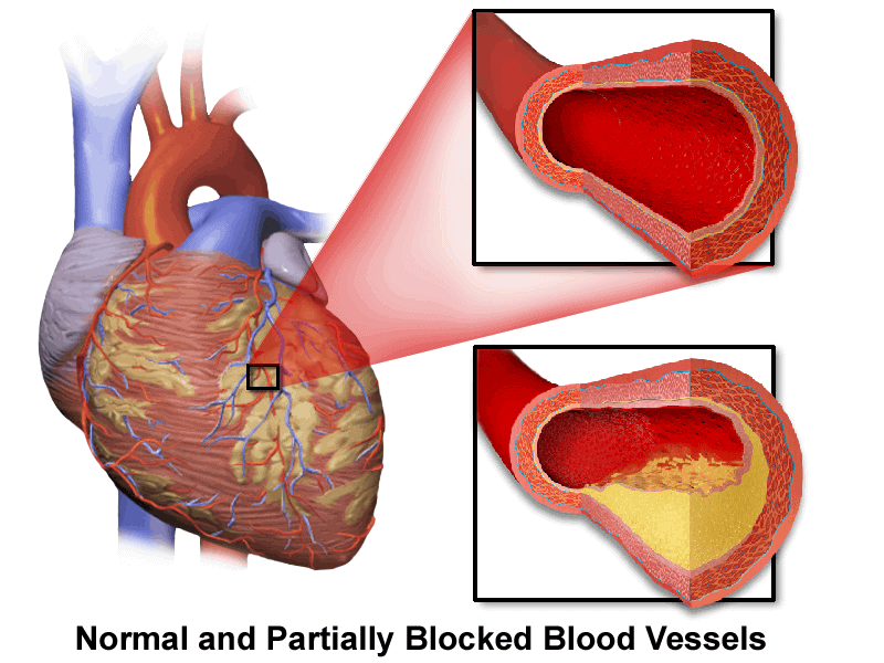 Coronary artery disease : कोरोनरी आर्टरी डिजीज क्या हैं? जानें इसके कारण, लक्षण और इलाज