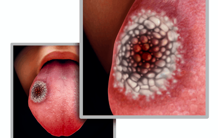 जीभ का कैंसर क्या है? कब बढ़ जाता है ये कैंसर होने का खतरा?