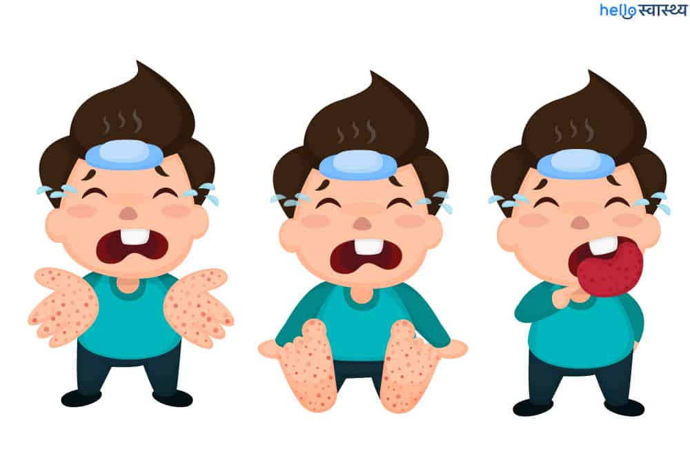 बच्चों के मुंह के अंदर हो रहे दाने हो सकते हैं 'हैंड फुट माउथ डिजीज' के लक्षण