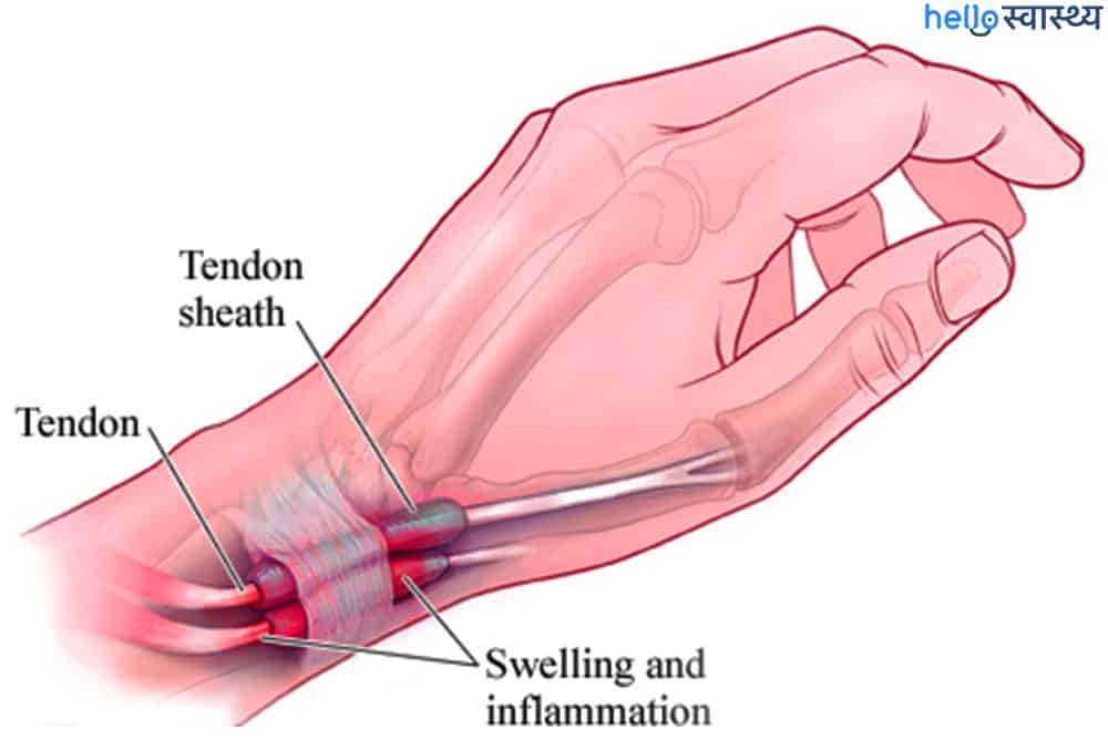 De Quervain Surgery: डीक्वेवेंस सर्जरी क्या है?