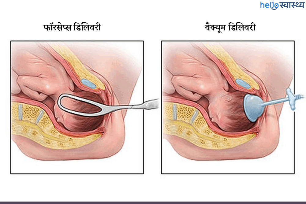 फॉरसेप्स वैक्यूम डिलिवरी क्या है?