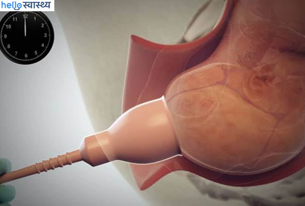 क्या वैक्यूम एक्सट्रैक्शन डिलिवरी से हो सकती है इंजुरी?