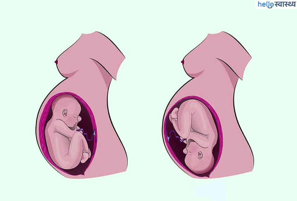 बेबी बर्थ पुजिशन, जानिए गर्भ में कौन-सी होती है बच्चे की बेस्ट पुजिशन