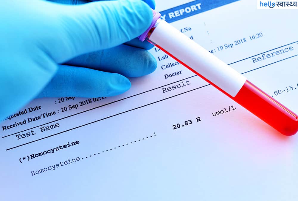 होमोसिस्टीन और मिसकैरिज का क्या है संबंध?