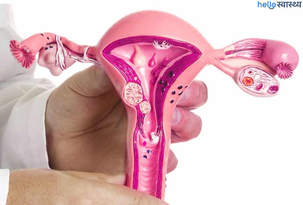 Endometrial Ablation: एंडोमेट्रियल एबलेशन क्या है?