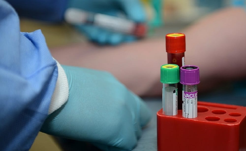 Lactic Acid Test : लैक्टिक एसिड टेस्ट क्या है?