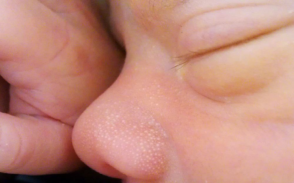 Milia : मिलीया क्या है? जानें इसके कारण, लक्षण और उपाय