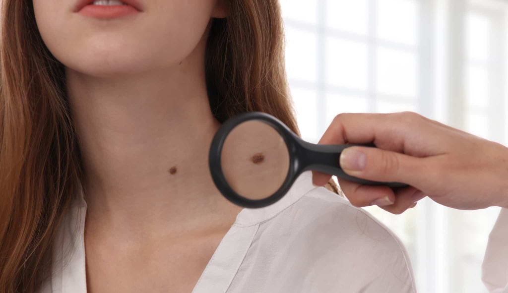 Moles on body-शरीर में तिल