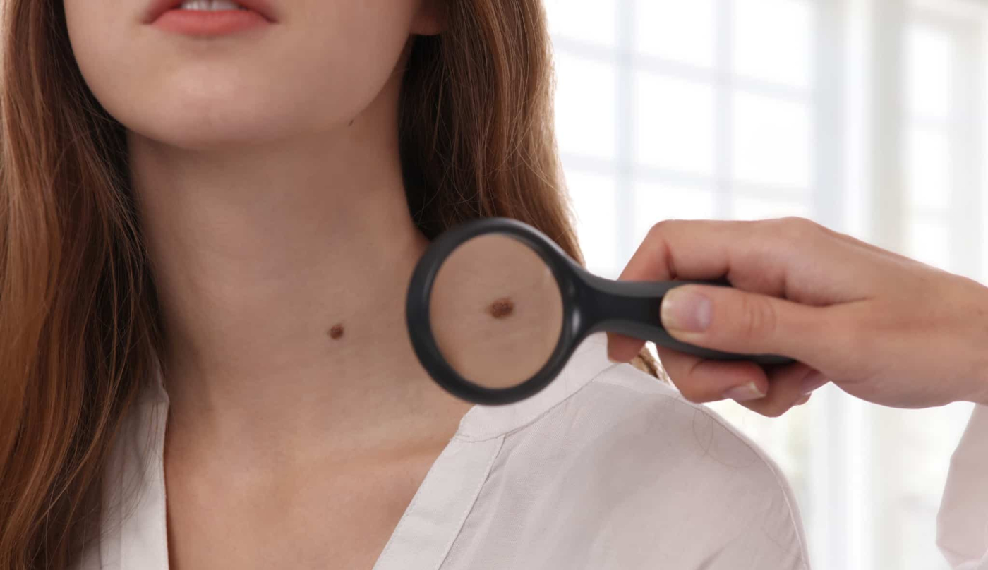 जानें शरीर में तिल और कैंसर का उससे कनेक्शन 