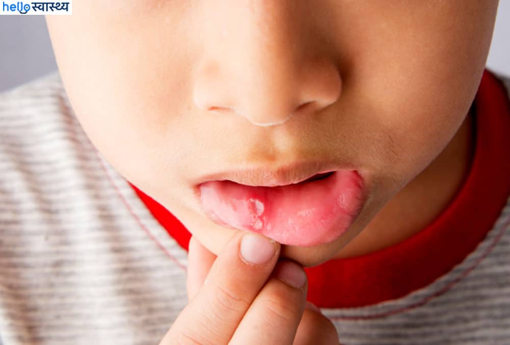 बच्चों में एपथस अल्सर (मुंह के छाले) की परेशानी कैसे समझें?