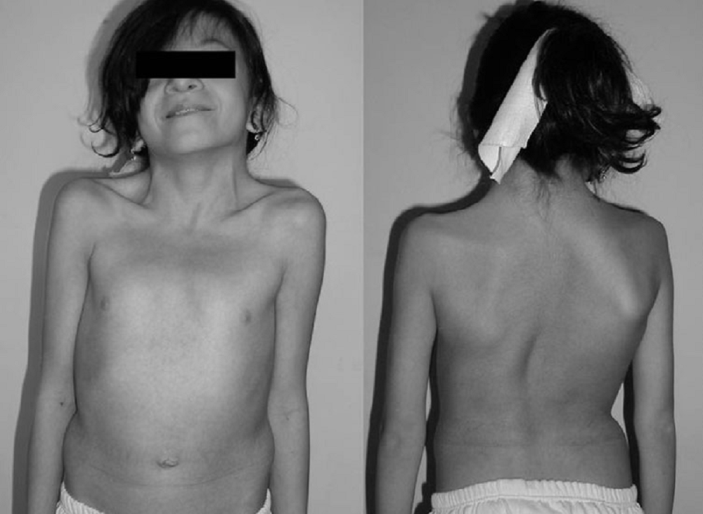 Noonan Syndrome : नूनन सिंड्रोम क्या है? जानिए इसके कारण, लक्षण और उपाय