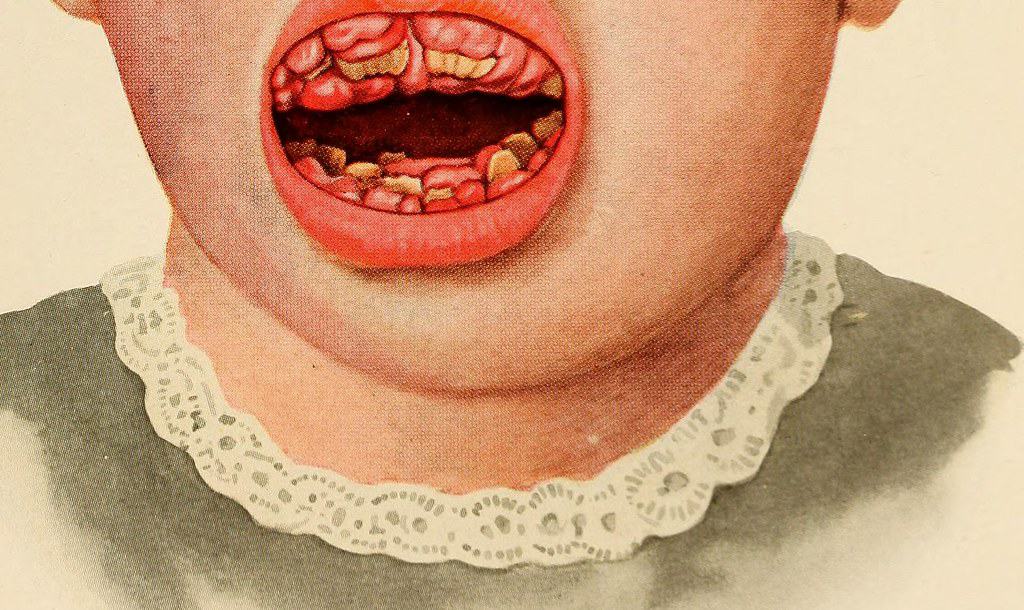 Scurvy : स्कर्वी रोग क्या है?