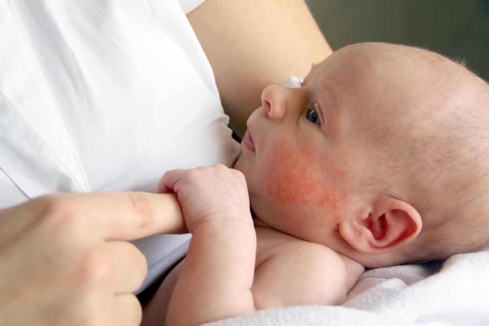 Dermatitis in child/बच्चों में डर्मेटाइटिस