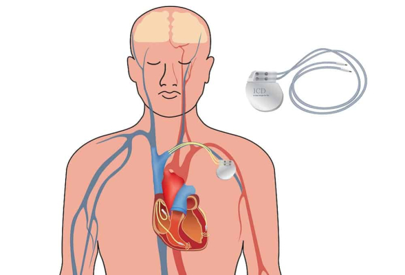 Pesmaker Pacemaker Implantation : पेसमेकर इम्प्लांटेशन क्या है ? जानिए प्रक्रिया ...