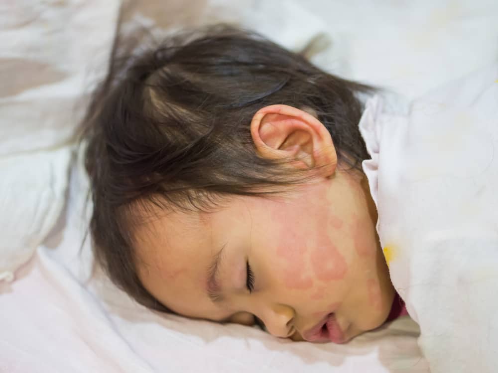 साबुन और लोशन से हो सकती है बच्चों में 'हाइव्स' की समस्या