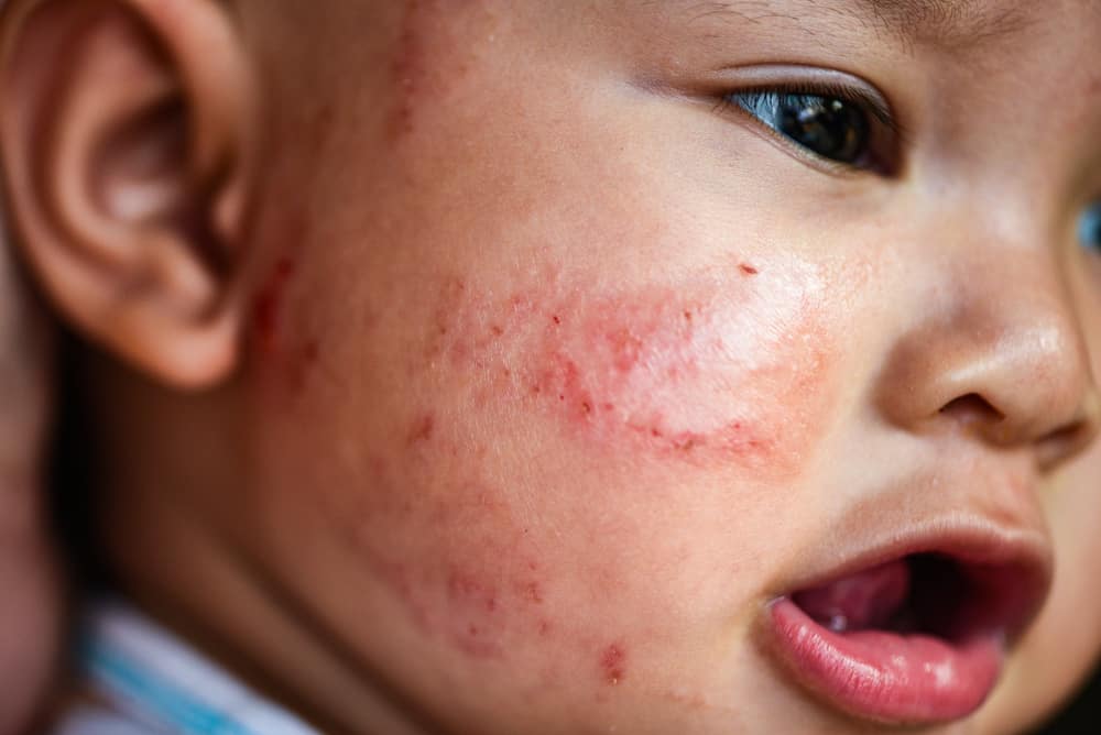 Skin Problems in child/बच्चों में स्किन की बीमारियां