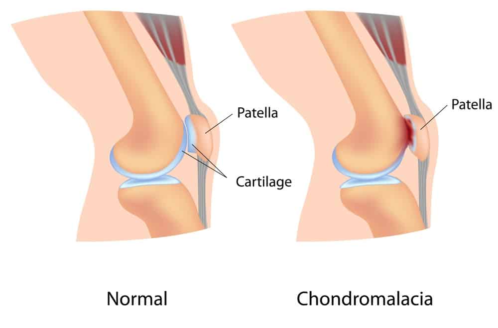 Chondromalacia Patella : कॉन्ड्रोमलेशिया पटेला क्या है? जानें इसके कारण, लक्षण और उपाय