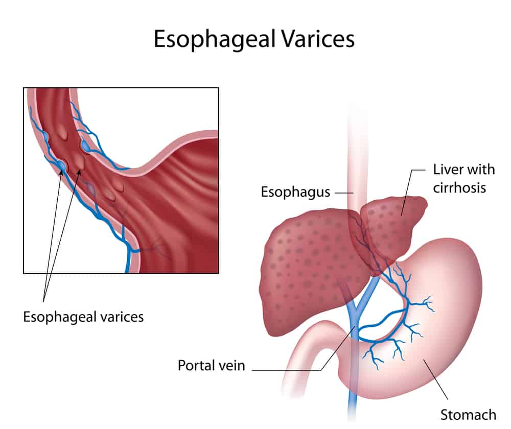 Esophageal Varices : इसोफेजियल वर्सिस क्या है?