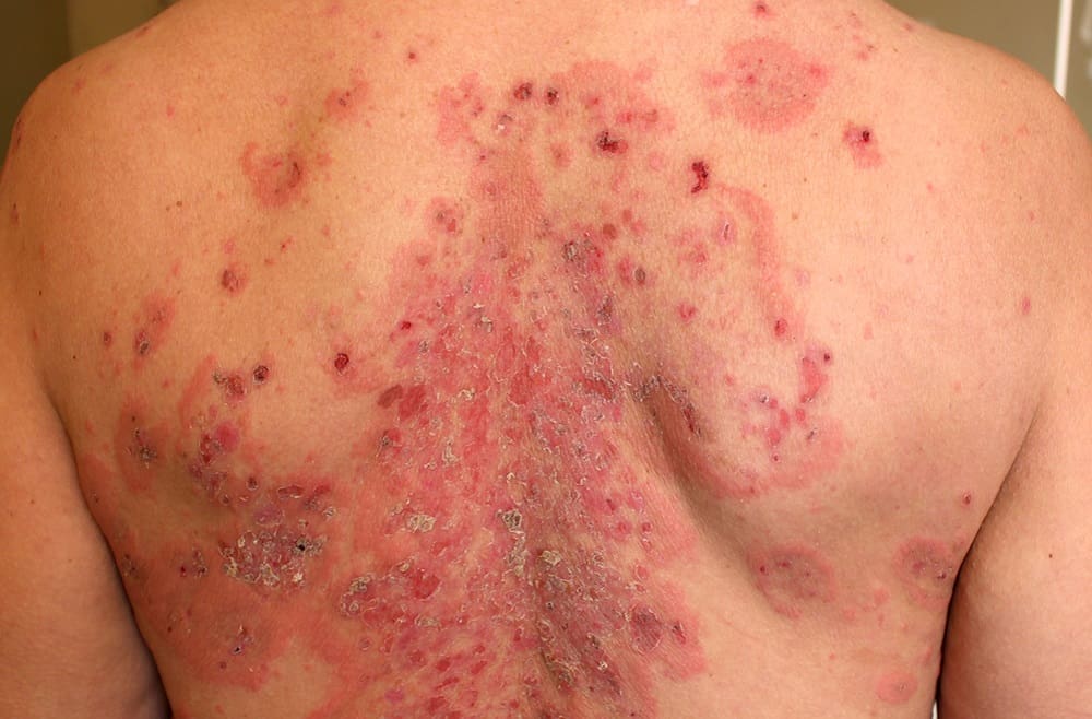 Pemphigus: पेम्फिगस क्या है?