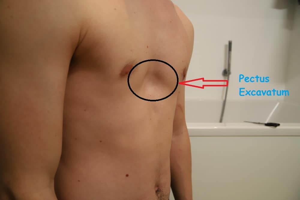 Pectus Excavatum : पेक्टस एक्सकावाटम क्या है?