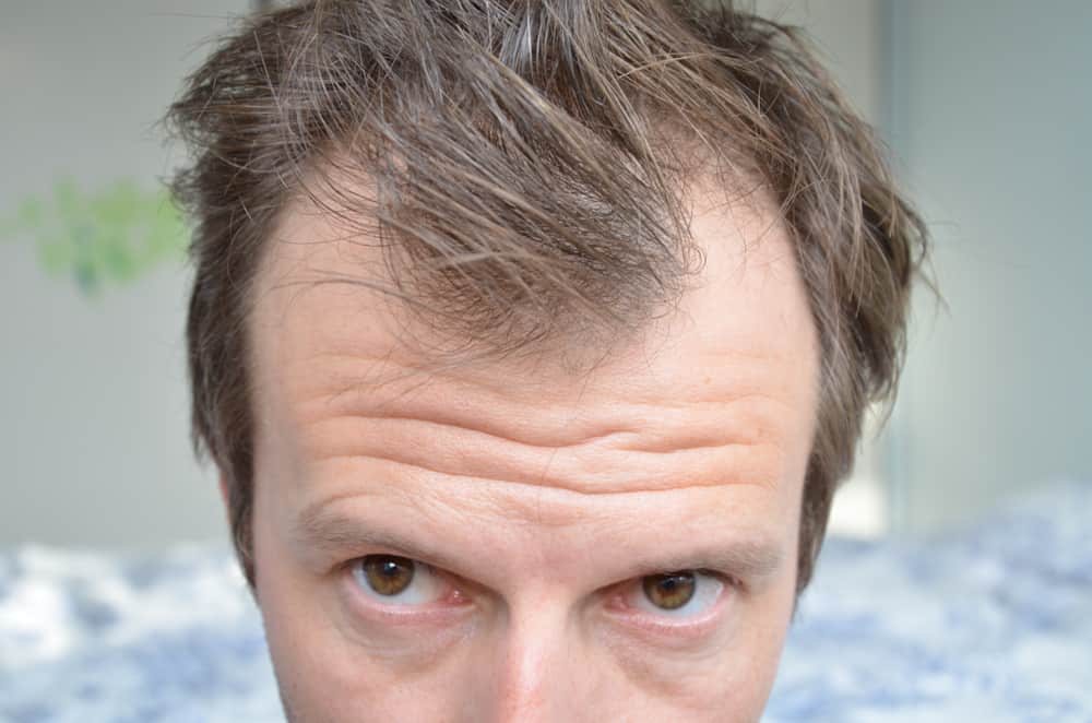 Telogen effluvium : टेलोजेन एफ्लुवियम क्या है?