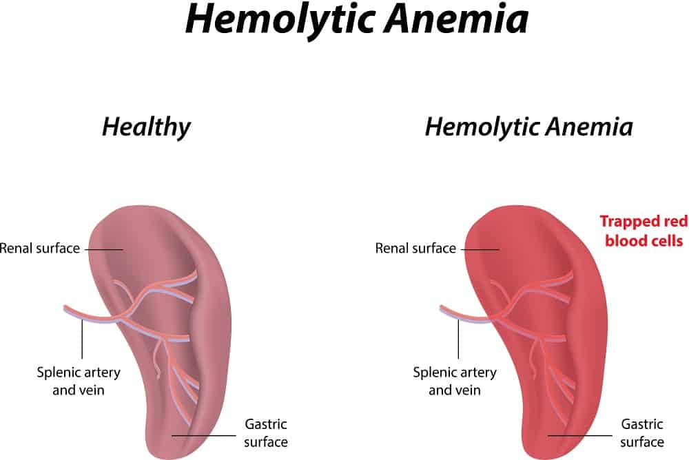 Haemolytic Anaemia: हीमोलिटिक एनीमिया क्या है? जानें इसके कारण, लक्षण और उपाय