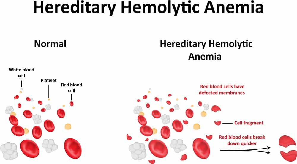 Hereditary Haemolytic Anaemia : वंशानुगत हीमोलिटिक एनीमिया क्या है?