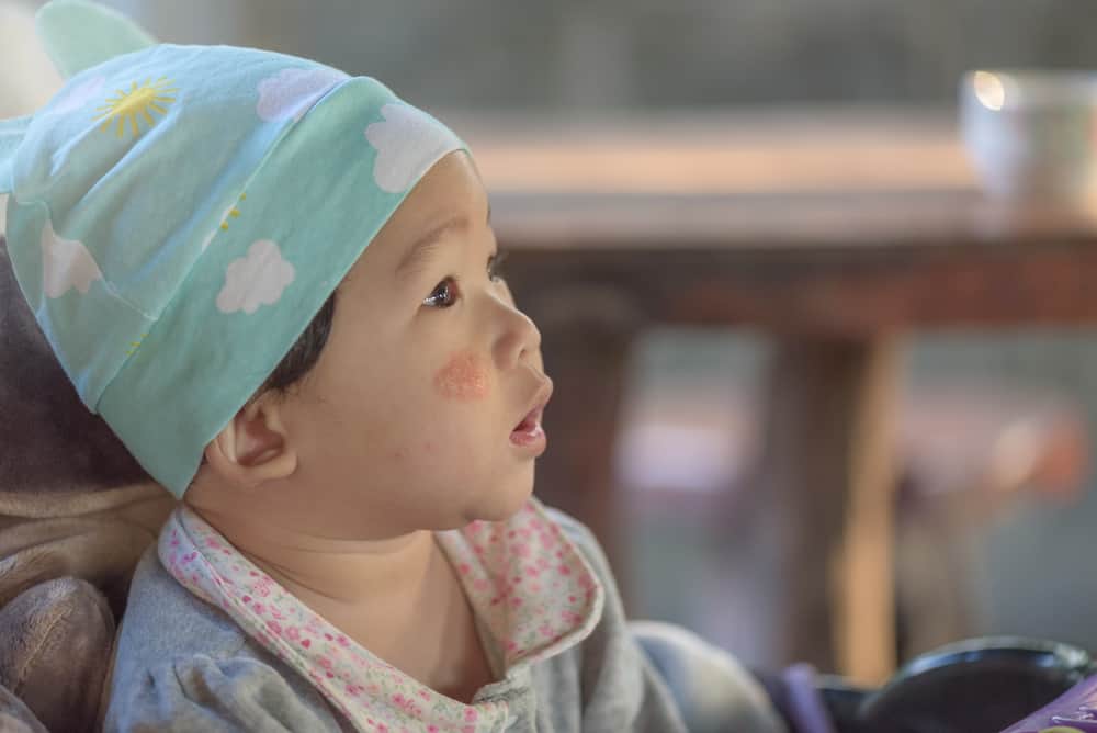 बच्चों में टिनिया के लक्षण गाल या बाल कहीं भी दिख सकते हैं