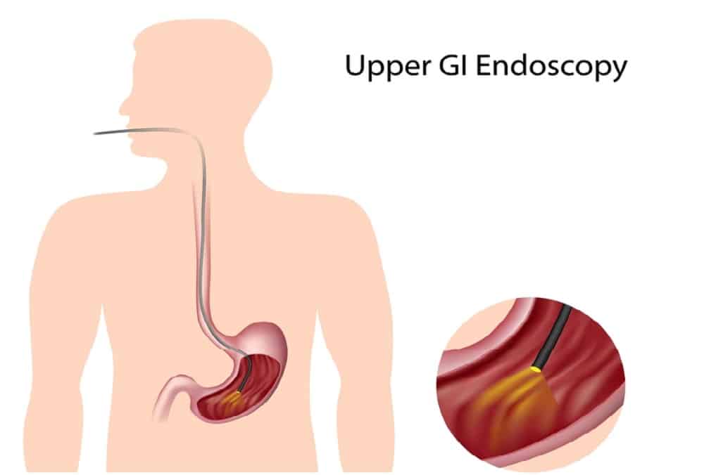 Upper Gastrointestinal Endoscopy : अपर गैस्ट्रोइंटेस्टाइनल एंडोस्कोपी क्या है?