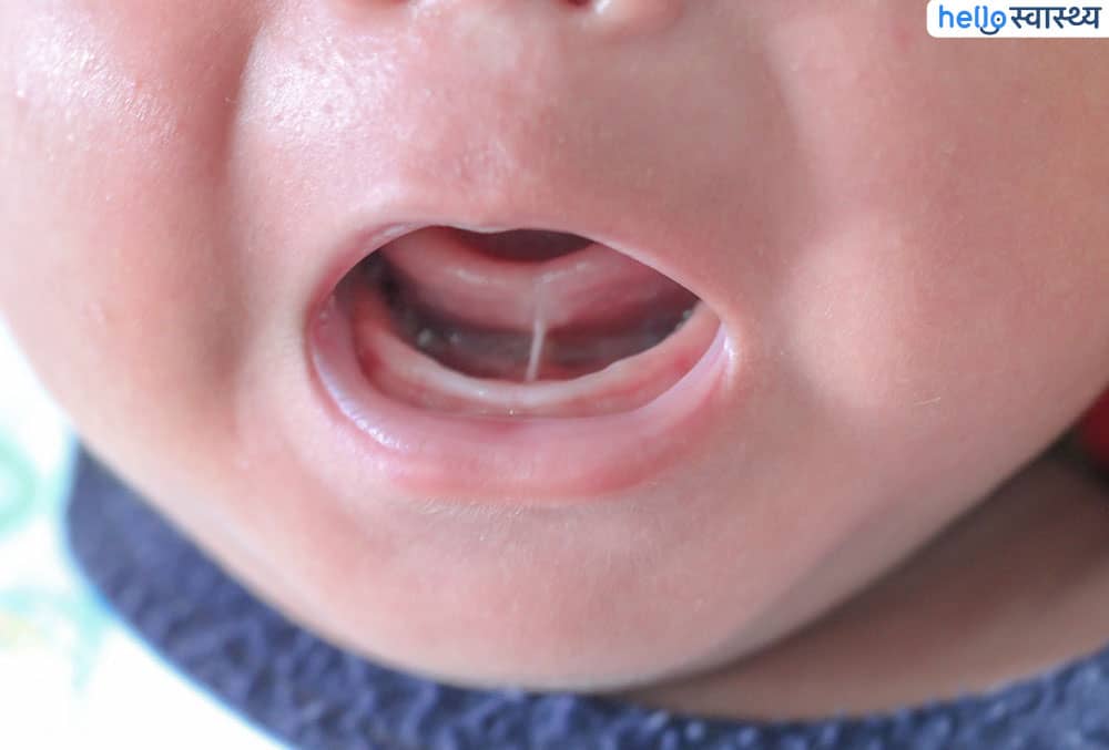 कभी आपने अपने बच्चे की जीभ के नीचे देखा? कहीं वो ऐसी तो नहीं?
