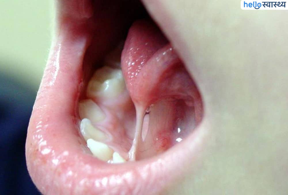 बच्चे का ठीक से नहीं बोलना, दूध नहीं पीना कहीं इस समस्या की ओर इशारा तो नहीं?