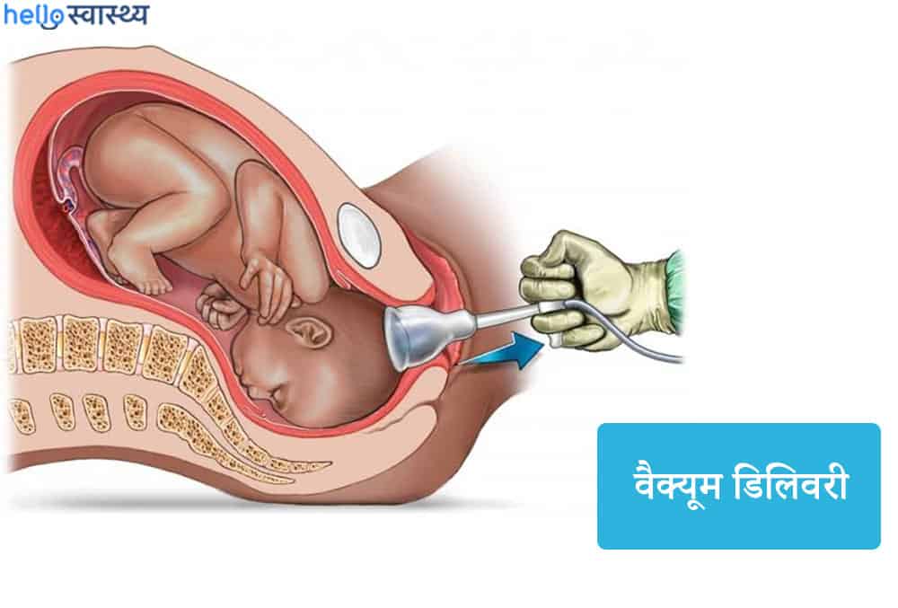 वैक्यूम डिलिवरी क्या है, क्यों पड़ती है इसकी जरूरत?