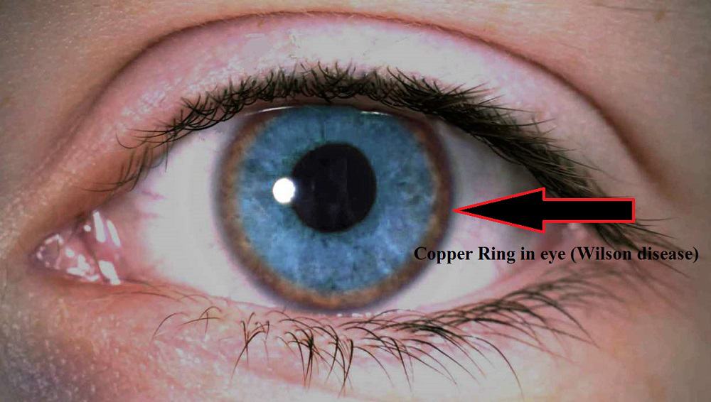 Wilson disease : विल्सन डिजीज क्या है?