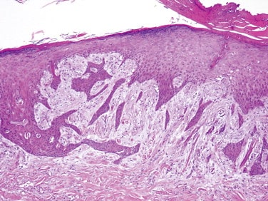 Epidermal: एपिडर्मल सिस्ट क्या है?