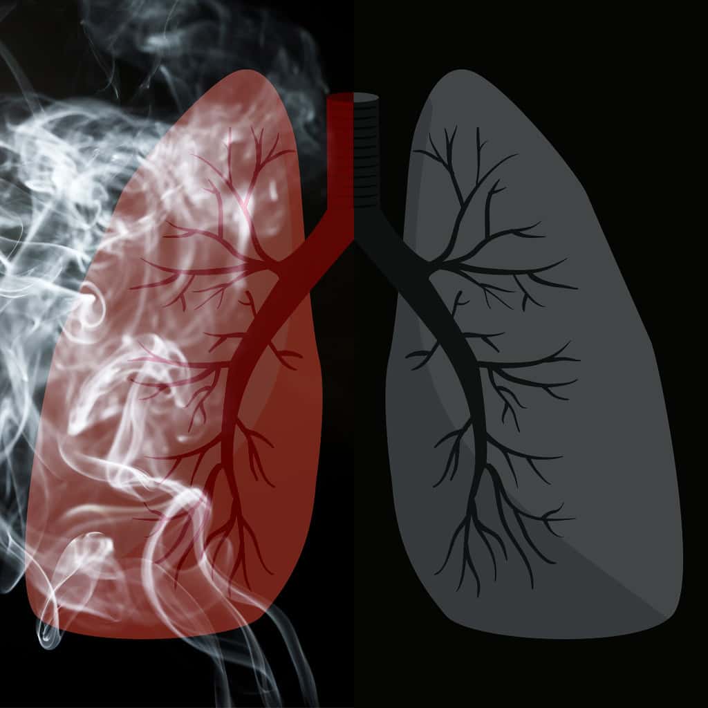 Histoplasmosis : हिस्टोप्लास्मोसिस क्या है?