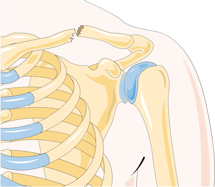 Broken Collarbone (Clavicle): कॉलरबोन टूटना क्या है? जानें इसके कारण, लक्षण और उपाय