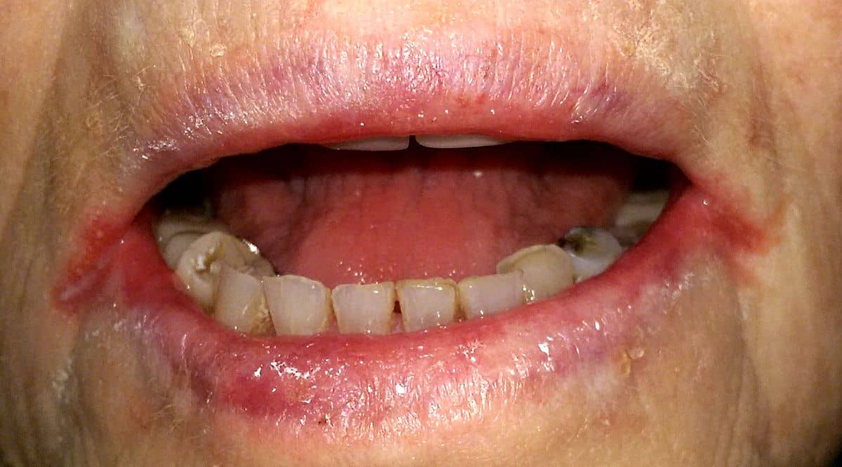 Angular Cheilitis : एंगुलर चेलाइटिस क्या है?