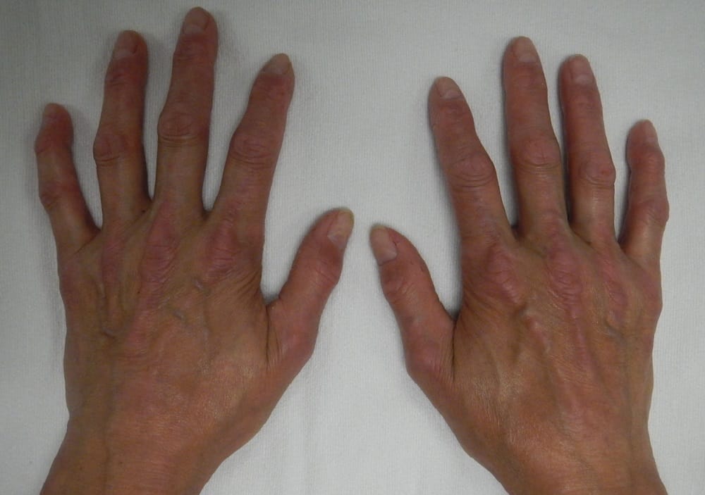 CREST Syndrome : क्रेस्ट सिंड्रोम क्या है?