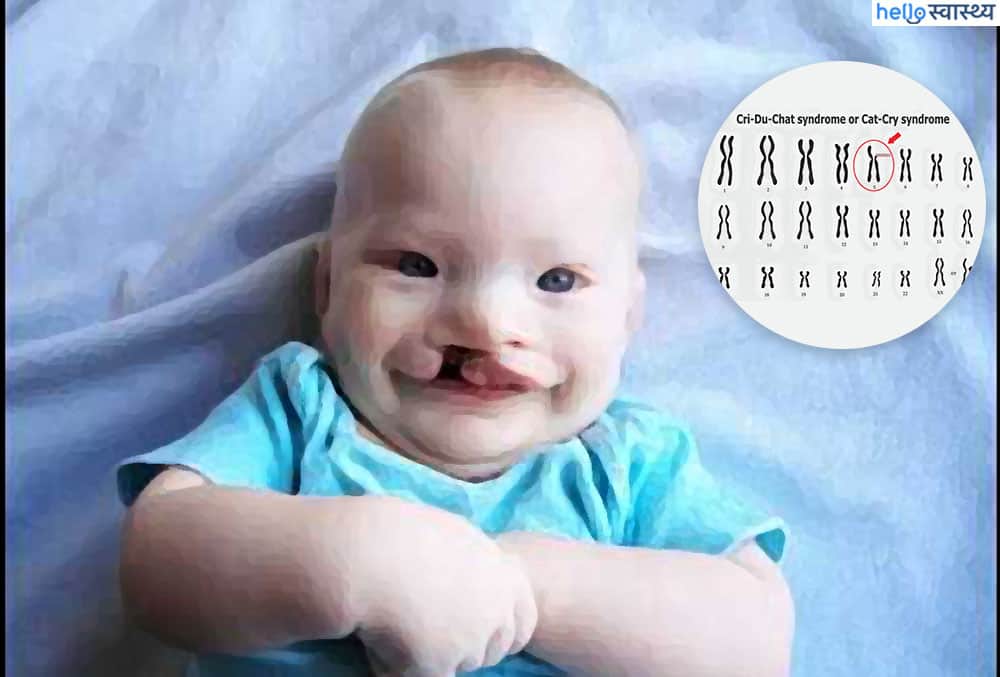 Cri Du Chat Syndrome : क्री दू शात सिंड्रोम क्या है? जानिए इसके कारण, लक्षण और इलाज