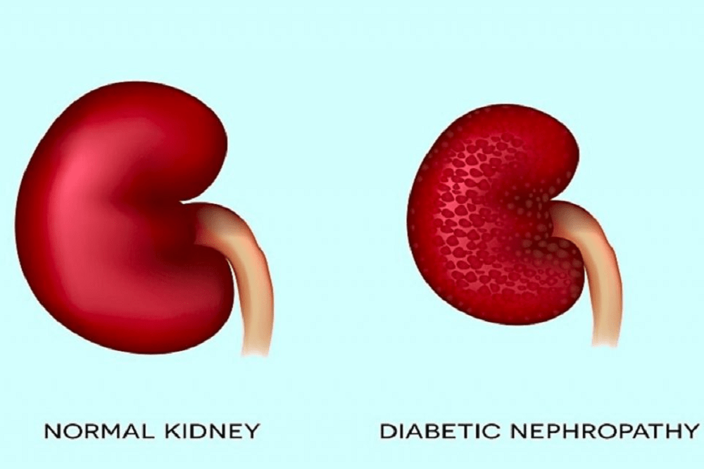Diabetic nephropathy: डायबिटिक नेफ्रोपैथी क्या है? जानें इसके कारण, लक्षण और इलाज