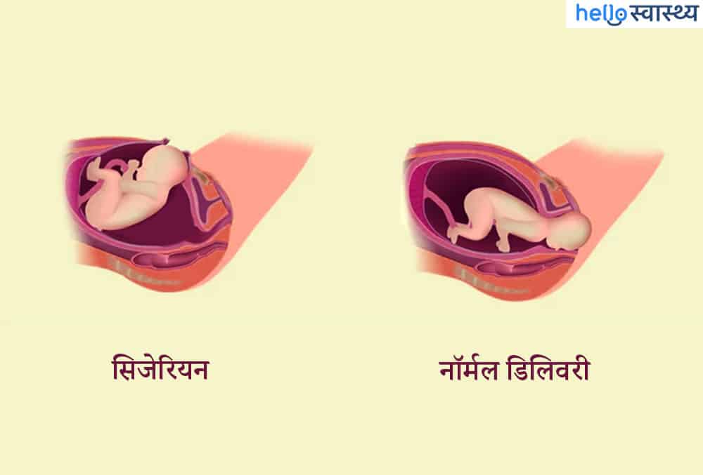 नॉर्मल डिलिवरी और सिजेरियन डिलिवरी में क्या अंतर है?