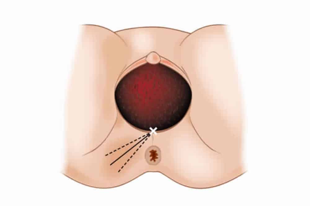 एपीसीओटॉमी प्रक्रिया के पहले और बाद में क्या सावधानियां रखनी चाहिए?