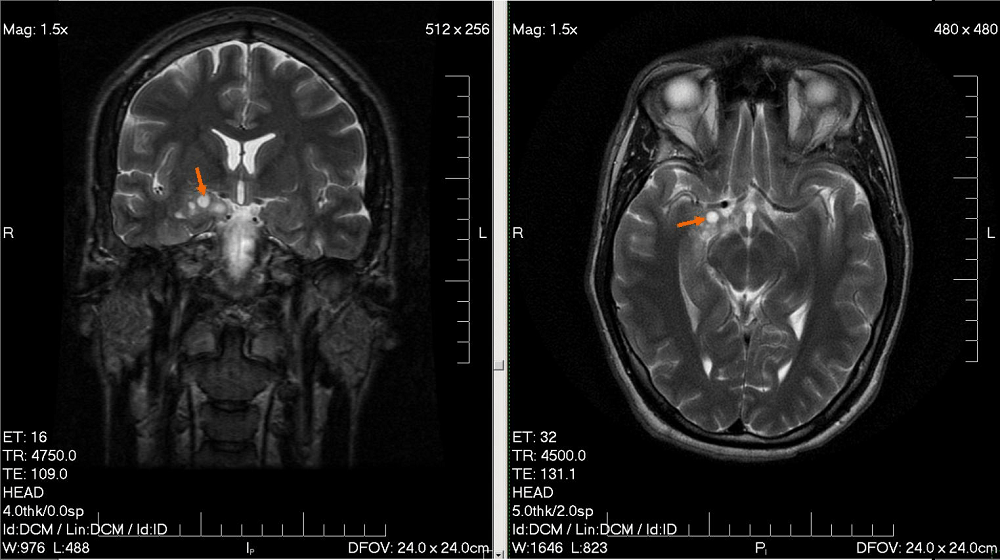 Glioma: ग्लिओमा क्या है?