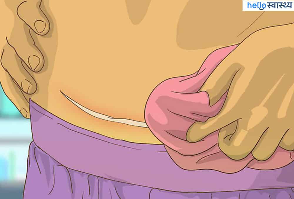 सी सेक्शन के बाद देखभाल कैसे करें?