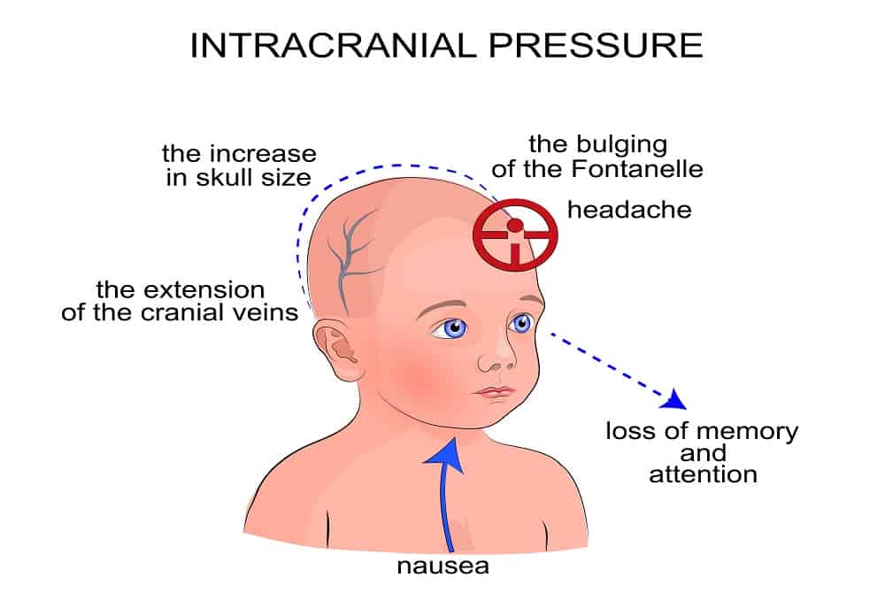 Increased Intracranial Pressure : इंक्रीस्ड इंट्राक्रेनियल प्रेशर क्या है?
